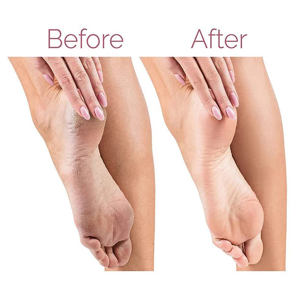 مبرد القدم الكهربائي لإزالة مسامير القدم Electric Pedicure Foot File Callus Remover